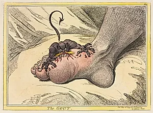 The Gout