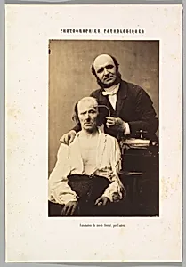 Faradisation du muscle frontal