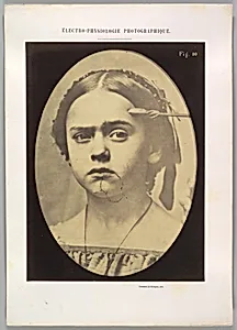 Figure 10: Showing the expressive lines of m. frontalis in a young girl by Guillaume-Benjamin-Amand Duchenne de Boulogne|Adrien Tournachon