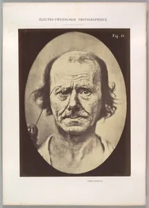 Figure 12: A study of the contraction of and the expression produced by the superior part of m. orbicularis oculi 