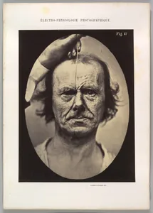 Figure 17: On the right, electrization of m. procerus: severity, aggression. On the left: attention. 