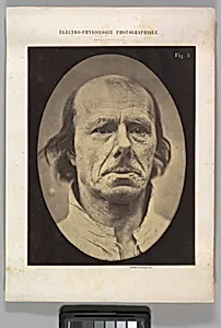 Figure 3: The face of an old man... photographed in repose. by Guillaume-Benjamin-Amand Duchenne de Boulogne|Adrien Tournachon