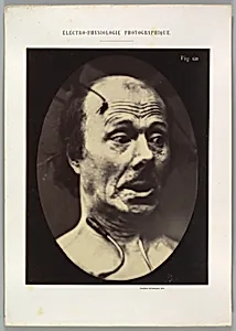 Figure 60: Fright by Guillaume-Benjamin-Amand Duchenne de Boulogne|Adrien Tournachon