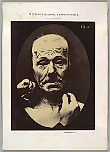 Figure 8: Contraction of the right m. frontalis.  by Guillaume-Benjamin-Amand Duchenne de Boulogne|Adrien Tournachon