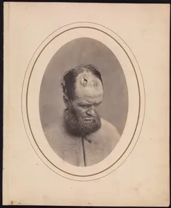 Private John Parkhurst, Company E, Second New York Heavy Artillery