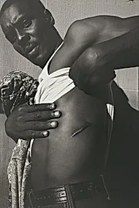 A 14th Street drug pusher shows one of his many knife wounds, shortly after this photo was taken he was stabbed again, New York City