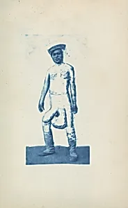 Elephantiasis