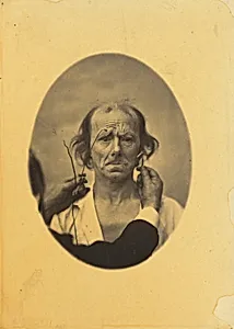 Plate 14: Designed to show a comparison between the maximal contraction of the superior part of m. orbicularis oculi and m. corrugator supercilii, in the same individual. On the left, very strong electrization of the superior part of m. orbicularis oculi: dissatisfaction, somber thoughts. On the right, electrization of m. corrugator supercilii.