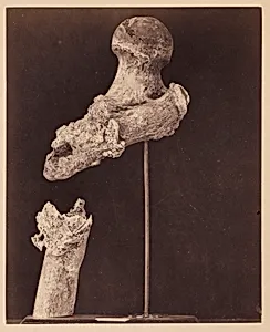 Lieutenant Goodwin, Deceased, Ununited Gunshot Fracture of the Upper Third of the Right Femur, Seven Months after the Injury, From the Photographic Catalogue of the Surgical Section
