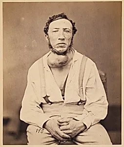 Mr. Joseph Brown, Aneurism of the Innominate Artery, from the Photographic Catalogue of the Surgical Section