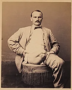 Private Charles Myer, Amputation of the Right Thigh, from the Photographic Catalogue of the Surgical Section