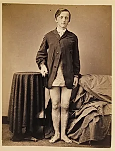 Private G. W. Warrington, Recovery, without Amputation, after Gunshot Fracture of the Right Patella, from the Photographic Catalogue of the Surgical Section