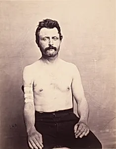 Private John Kelly, Successful Primary Excision of Four inches of the Upper Third of the Shaft of the Right Humerus for Gunshot Fracture, from the Photographic Catalogue of the Surgical Section