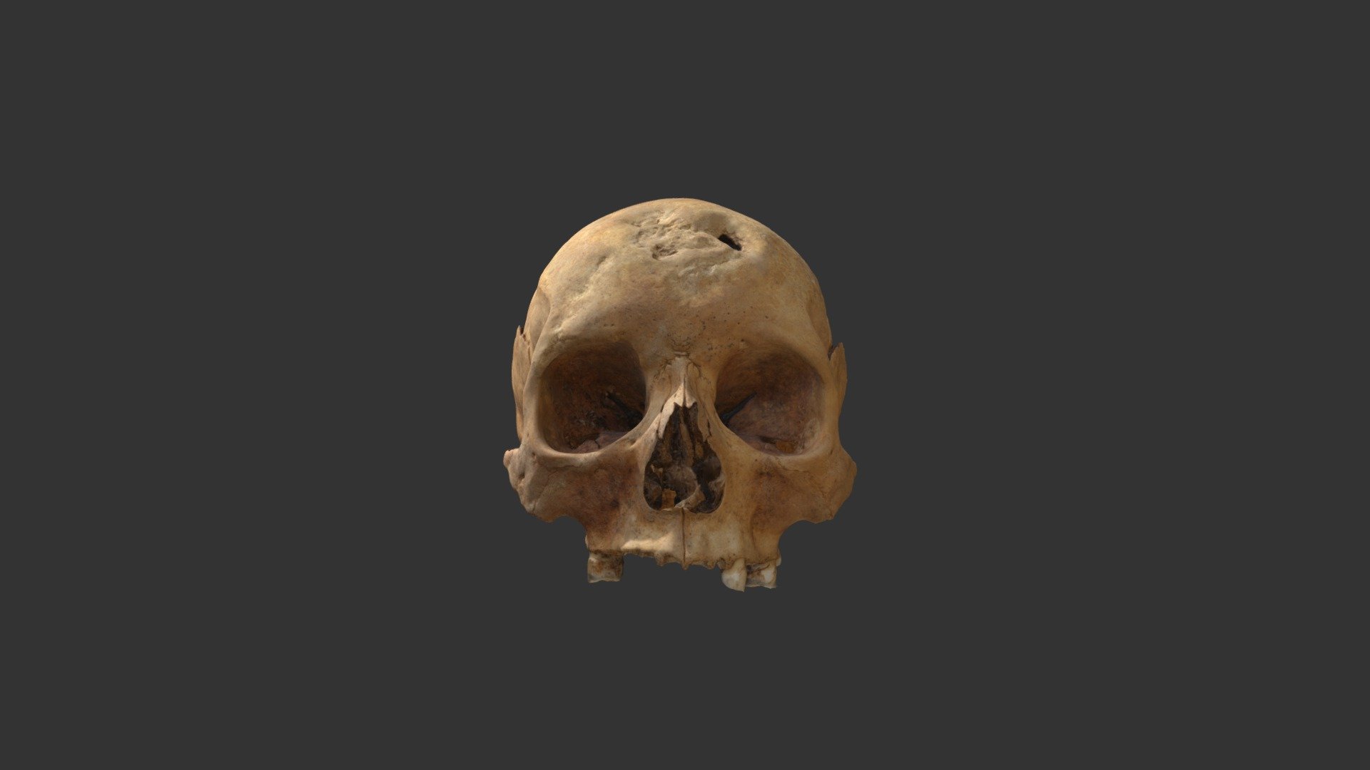 Skull showing treponemal disease (syphilis)