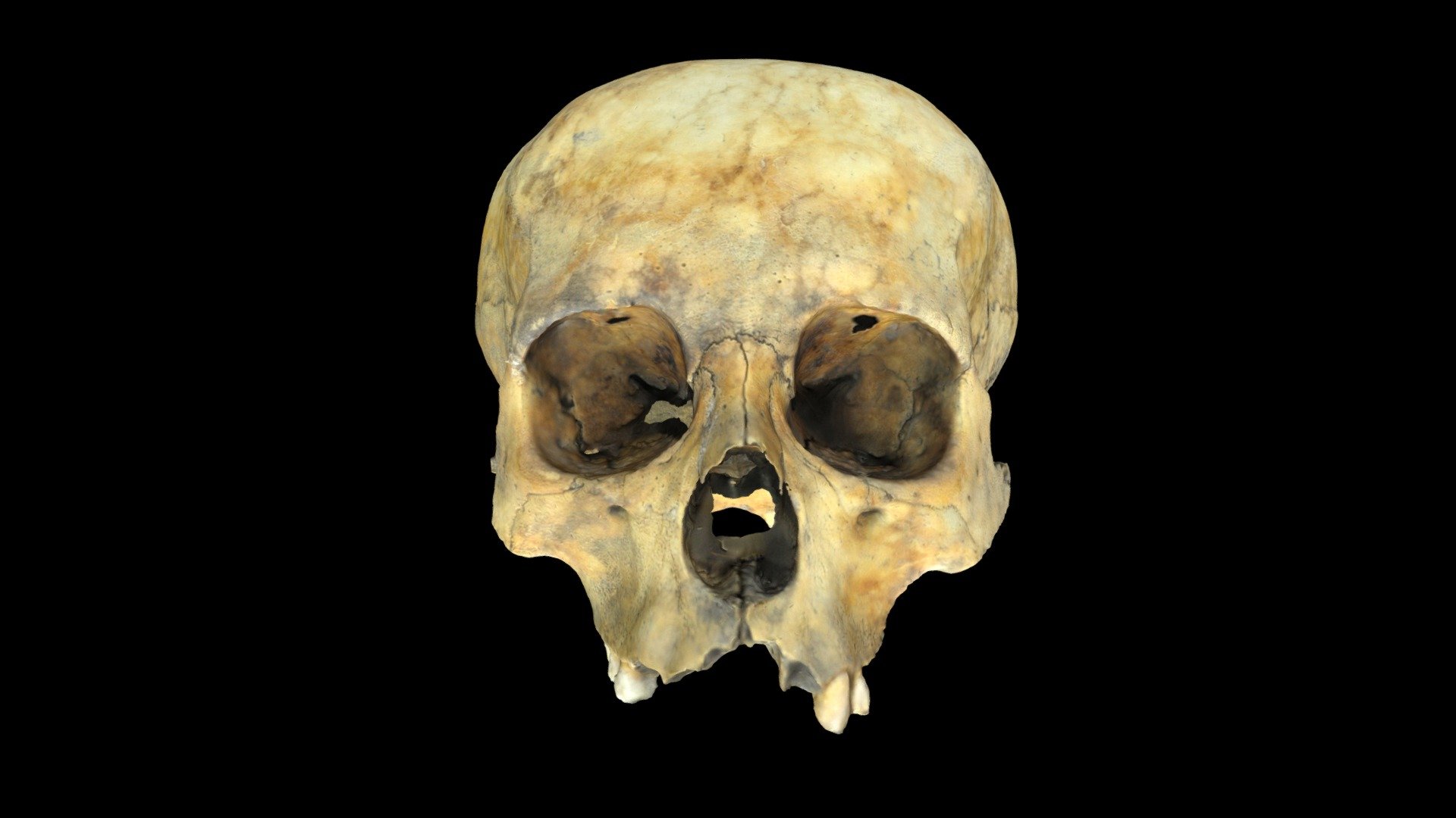 Craneo modificado